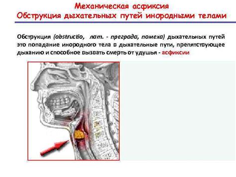 Что такое обструкция