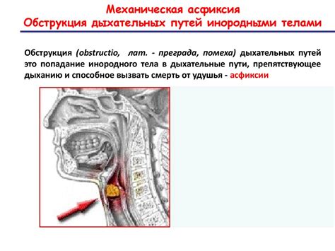 Что такое обструкция дыхательных путей у ребенка?