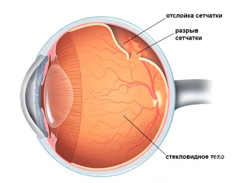 Что такое отслаивание сетчатки глаза?