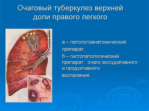 Что такое очаговый туберкулез верхней доли левого легкого?