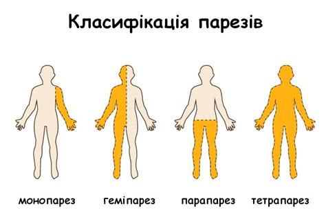 Что такое парез лица и парез конечности?