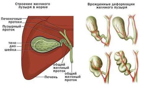 Что такое перекрут желчного пузыря