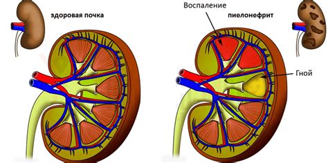 Что такое пиелонефрит