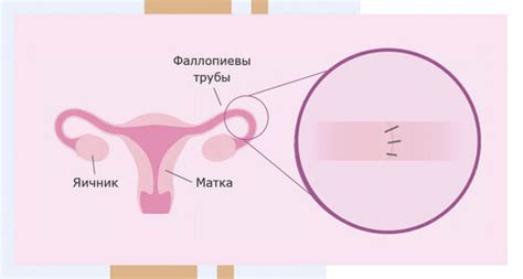 Что такое пластика маточных труб?