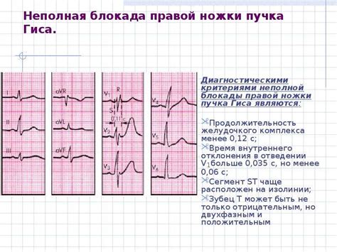 Что такое полная блокада правой ножки пучка Гиса?