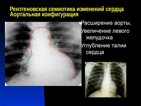 Что такое поперечное увеличение сердца?