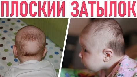 Что такое приплюснутый затылок у ребенка?