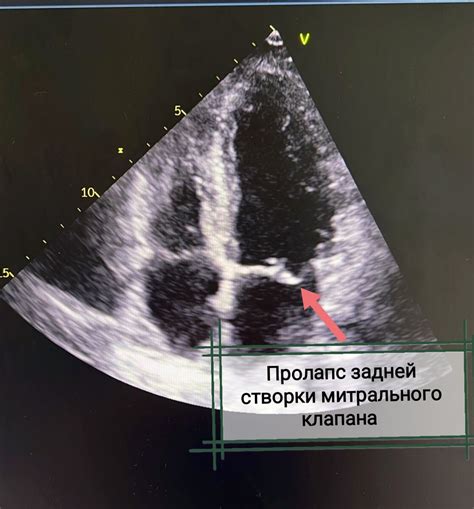 Что такое прогибание передней створки митрального клапана