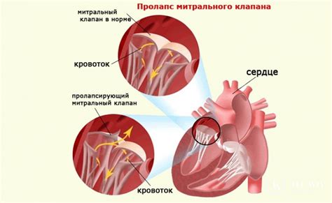 Что такое пропускает клапан сердца?