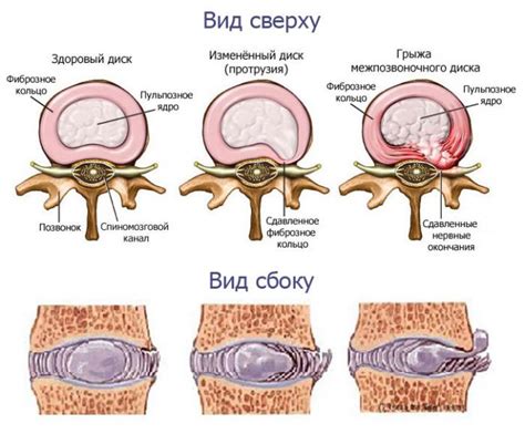 Что такое протрузия межпозвоночных дисков?