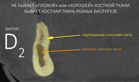 Что такое разрежение костной ткани зуба