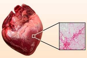 Что такое рубцовое поражение миокарда