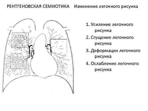 Что такое сгущение корней легких?