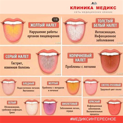 Что такое серый налет на языке?