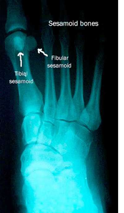 Что такое сесамовидная кость и для чего она нужна?