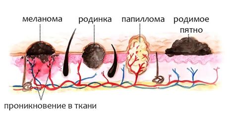 Что такое смешанный меланоформный невус?