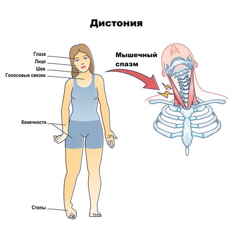 Что такое спастичность мышц и ее проявления?