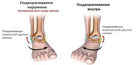 Что такое субтотальное повреждение связки?