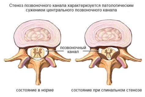 Что такое суженный просвет позвоночного канала?