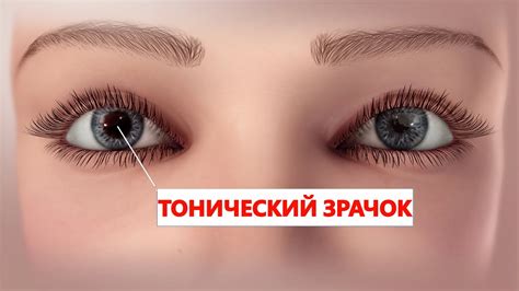 Что такое сузившиеся зрачки