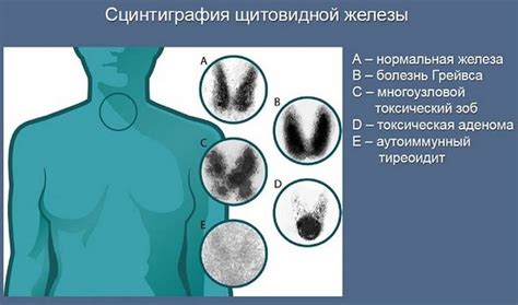 Что такое сцинтиграфия щитовидной железы?