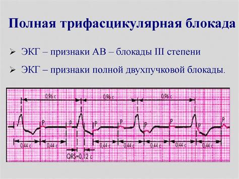 Что такое транзиторная ав блокада 1 степени?