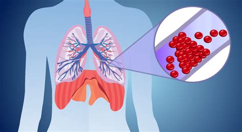 Что такое тромб легких?
