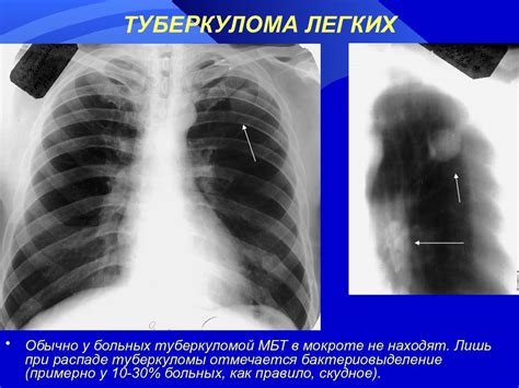 Что такое туберкулема