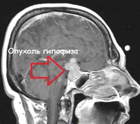 Что такое увеличение гипофиза головного мозга