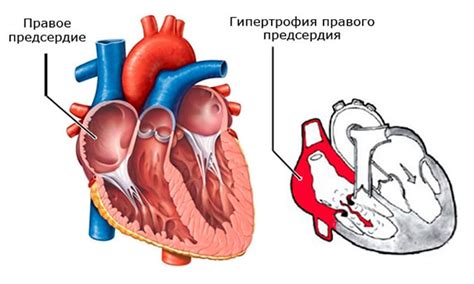 Что такое увеличение правого предсердия