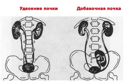 Что такое удвоенная почка