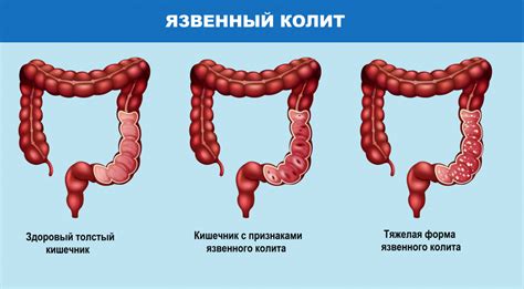 Что такое ульцерозный колит и его признаки