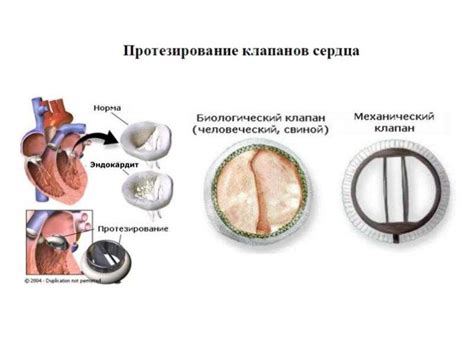 Что такое уплотнение створок трикуспидального клапана?