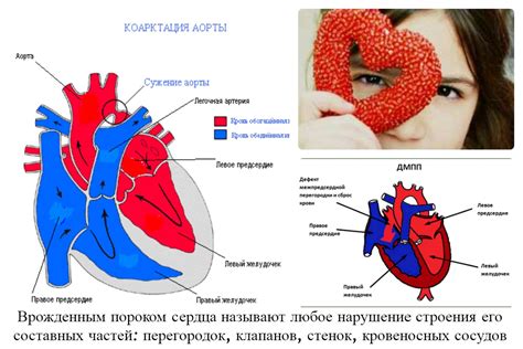 Что такое ущемление сердца?