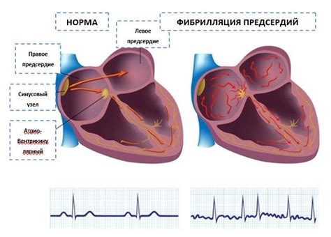 Что такое фибрилляция предсердий?