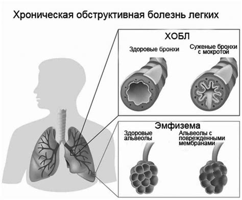 Что такое хобл легких