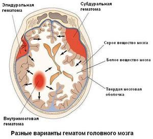 Что такое хроническая субдуральная гематома