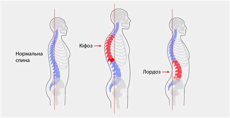 Что такое шейный кифоз и чем он опасен?