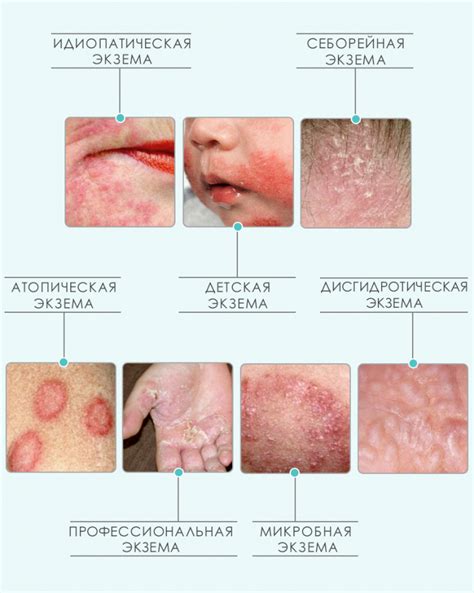 Что такое экзема и как ее распознать?
