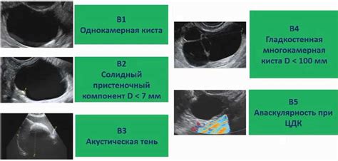 Что такое эхогенность миометрия? Влияние на женское здоровье