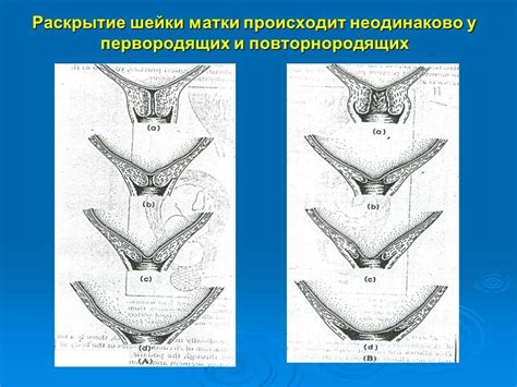 Шейка матки: открытие на два пальца