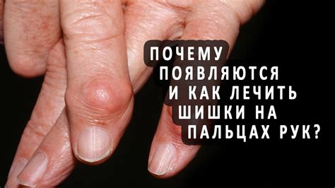 Шишки на пальцах: что это за проблема и как ее лечить?