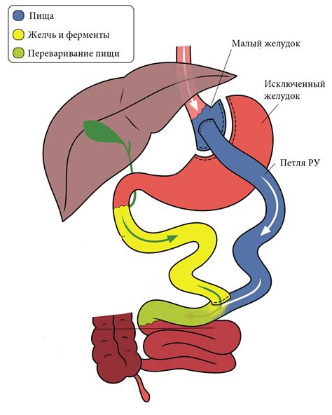 Шунтирование желудка в медицинском контексте