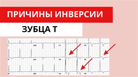 ЭКГ инверсия зубца Т: все о значении и влиянии на сердце