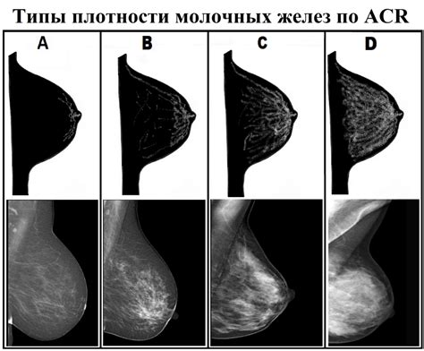 Экстренные ситуации и тип строения молочных желез