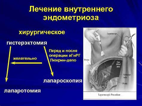 Эндометриоз средней поздней