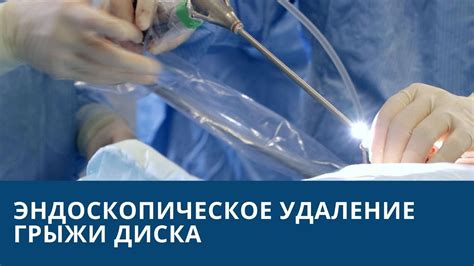 Эндоскопическое удаление: решение проблемы без операции