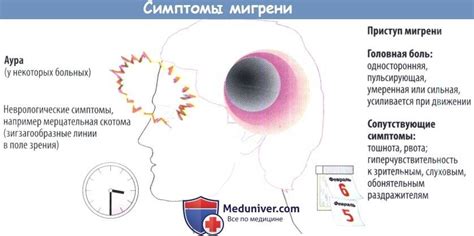 Эпизодическая мигрень без ауры