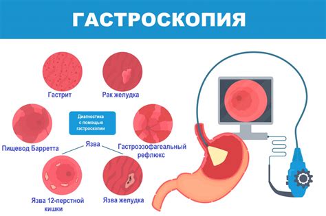 Эрозивный атрофический гастрит: причины, симптомы и лечение