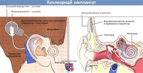 Этапы кохлеарной имплантации